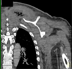 Abscess in Intravenous Drug Abuse (IVDA) - CTisus CT Scan