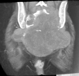 Chordoma - CTisus CT Scan