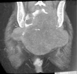 Chordoma - CTisus CT Scan