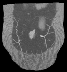 3D for DIEP Flap Planning - CTisus CT Scan