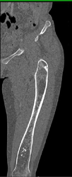 Erlenmeyer Flask Femur - CTisus CT Scan