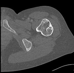 Exostosis - CTisus CT Scan