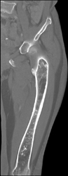 Exostosis - CTisus CT Scan