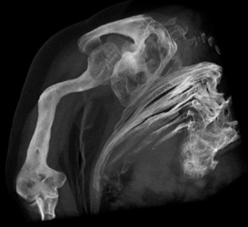 Osteogenesis Imperfecta - CTisus CT Scan