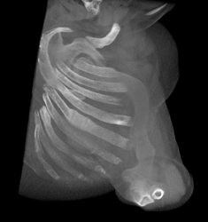 Osteogenesis Imperfecta - CTisus CT Scan