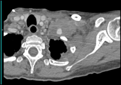 Supraclavicular Abscess in Intravenous Drug Abuse (IVDA) With Pseudoaneurysm - CTisus CT Scan