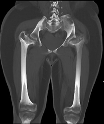 Achondroplasia - CTisus CT Scan