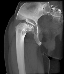 Dysplastic Hip - CTisus CT Scan