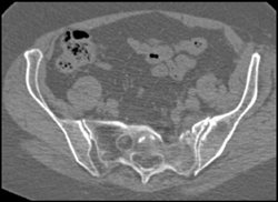 Sacral Fracture - CTisus CT Scan