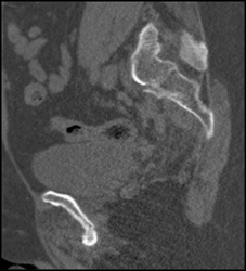 Sacral Fracture - CTisus CT Scan