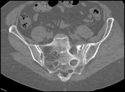 Sacral Fracture - CTisus CT Scan