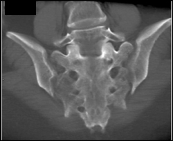 Sacral Fracture - CTisus CT Scan