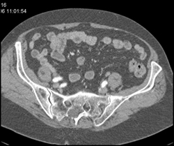 Marfan With Tarlov Cyst - CTisus CT Scan