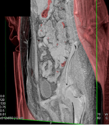 DIEP Flap Mapping - CTisus CT Scan