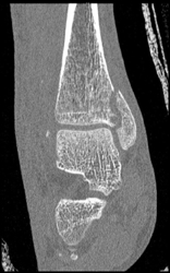 Tibial Fracture - CTisus CT Scan