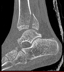 Tibial Fracture - CTisus CT Scan