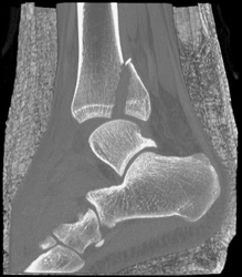 Tibial Fracture - CTisus CT Scan