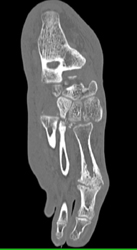 Tarsal Fractures - CTisus CT Scan