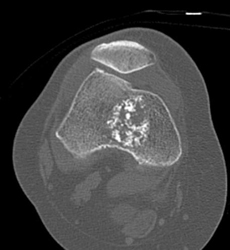 Enchondroma - CTisus CT Scan