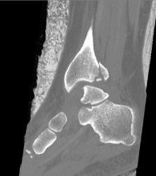 Tibial Fracture - CTisus CT Scan