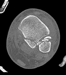 Tibial Fracture - CTisus CT Scan