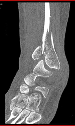 Tibial Fracture - CTisus CT Scan