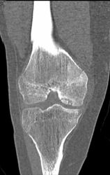 Prior Avascular Necrosis (AVN) of the Femur - CTisus CT Scan