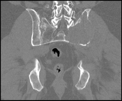 Metastatic Renal Cell Carcinoma - CTisus CT Scan