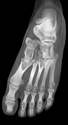 Nice Metatarsals - CTisus CT Scan