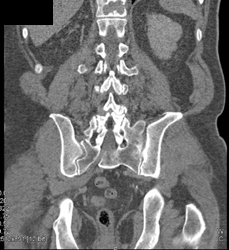 Metastatic Renal Cell Carcinoma to Left Acetabulum - CTisus CT Scan