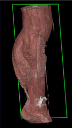 Comminuted Fractures With Soft Tissue and Muscle Injury - CTisus CT Scan