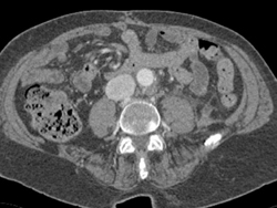 Psoas Abscess - CTisus CT Scan