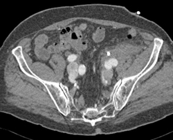 Psoas Abscess - CTisus CT Scan