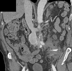 Psoas Abscess and Aorta/IVC Fistulae - CTisus CT Scan