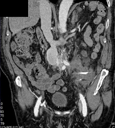 Psoas Abscess S/P Aortic Aneurysm Repair - CTisus CT Scan