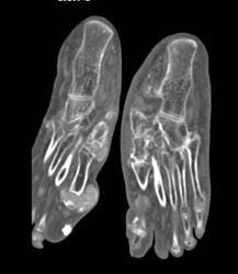 Gout - CTisus CT Scan