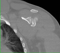 Scapular Fracture in 2d and 3D - CTisus CT Scan