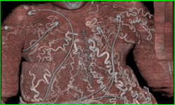 Collaterals in Chest Abdominal Wall - CTisus CT Scan