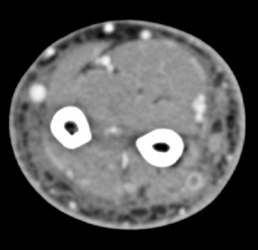 Deep Vein Thrombosis (DVT) - CTisus CT Scan