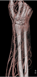 Cellulitis - CTisus CT Scan