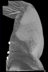 Cellulitis on CTA - CTisus CT Scan