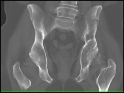 Myeloma - CTisus CT Scan