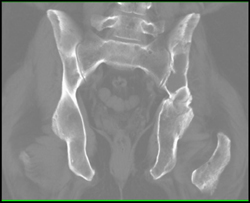 Myeloma - CTisus CT Scan