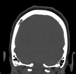 Bone Metastases - CTisus CT Scan