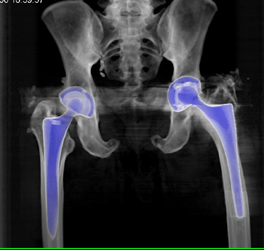 Failed Left Total Hip Replacement (THR) - CTisus CT Scan