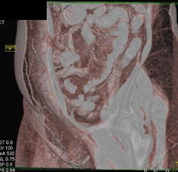 DIEP Flap Planning - CTisus CT Scan