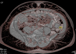 DIEP Flap Planning - CTisus CT Scan