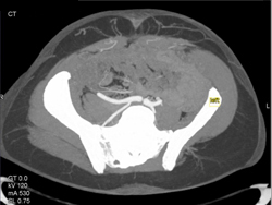 DIEP Flap Planning - CTisus CT Scan