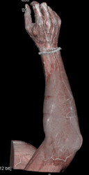 Cellulitis - CTisus CT Scan