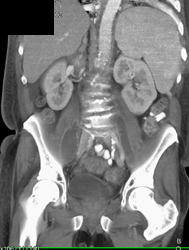 Bilateral Psoas Abscess - CTisus CT Scan